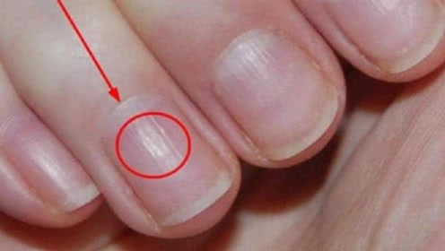 为什么有的人指甲上有竖纹,是身体在暗示什么?看完要注意了