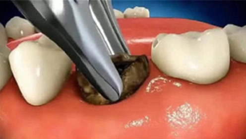 有了蛀牙怎么办?3d动画模拟拔牙全过程,看完你还畏惧去看牙医吗?