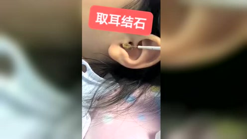 多年的耳结石终于有救了,取出来的那一刻耳朵舒服多了!