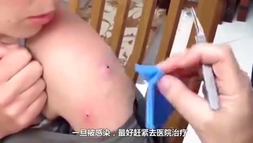 非洲寄生虫有多"厉害"?女孩被感染后,结果挤出"它"