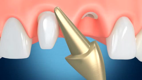 牙体缺损安装金属桩
