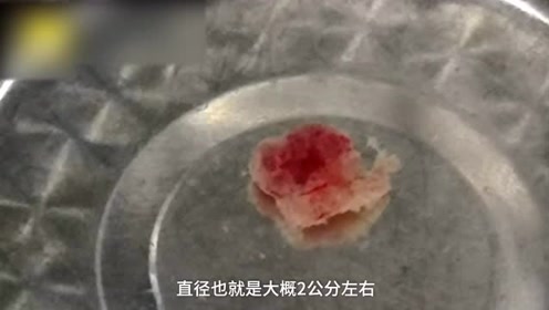 26岁女子宫外孕,胚胎竟长肝脏上,医生:从业22年第一次见