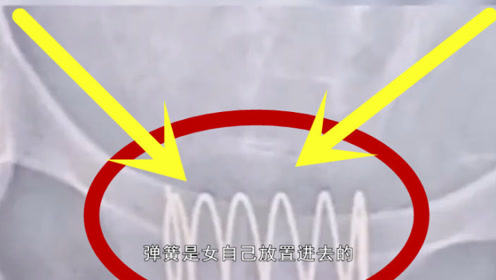 为避孕自己上环?女子捡来"弹簧",洗了一下放进"身体"!