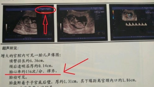 胎儿性别很容易判断,全部隐藏在b超单上,只有你傻傻不知道!
