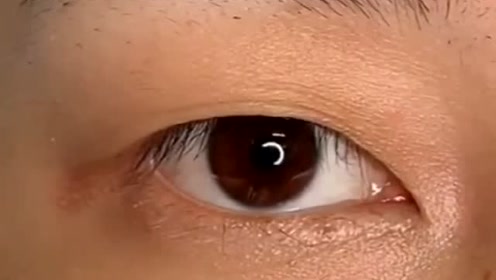 眼皮松弛有很多层皮的单眼皮该怎么调整?一定是你美目贴选的不对