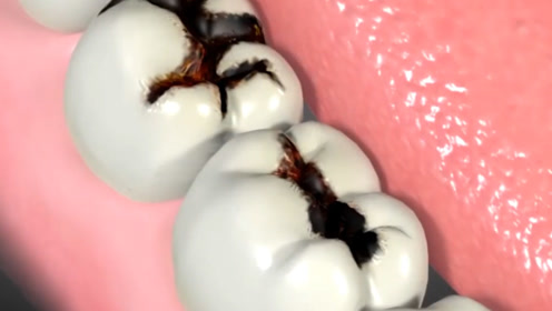 蛀牙真是被"虫子"吃空的吗?3d动画演示过程,网友:看着都疼