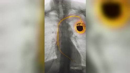 心脏起搏器,装还是不装?请以生之名严选