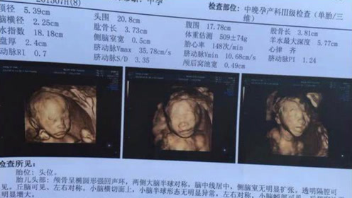 胎儿性别自己也能知晓?医生决口不提的秘密,b超单子上可见端倪