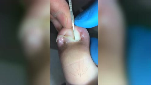 实拍治疗甲沟炎,嵌甲太深了,挖出来疼的哎呀了一声!