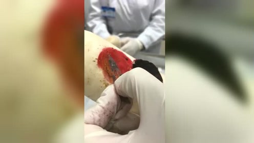 来实习的护士上手体验割痔疮,隔着屏幕都疼,以后再也不吃萝卜了
