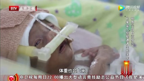 生命缘:巴掌婴儿出生21天,每吨才能吃8毫升,体重还不到1000克