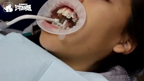 美女戴牙套的全过程技法课是什么意思图片