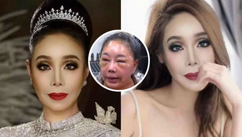 泰国59岁女富商想靠整容重返30岁 一个月后这脸没法看了