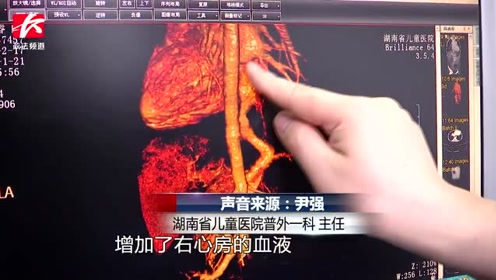5岁男童反复咳嗽患上罕见血管畸形,医生:静脉导管未闭合