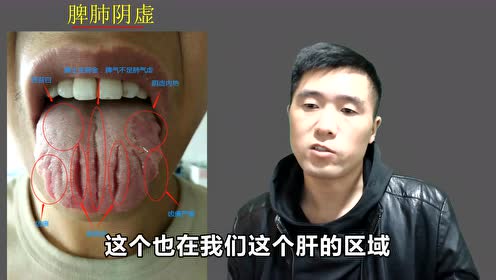 30岁小伙阴虚内热,导致舌头大裂纹,常喝地黄汤,滋阴清热散外