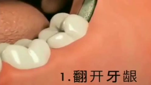 怪不得拔颗智齿要一千多块呢,原来工序这么复杂,看完牙疼!