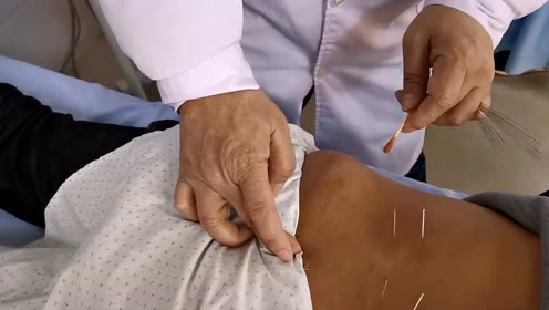 腰腿痛很多是腰椎间盘突出引起,专家教你如何针灸治疗
