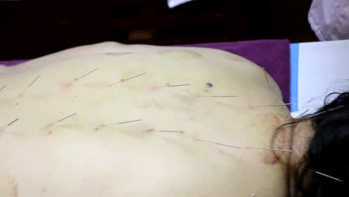 背部针灸减肥