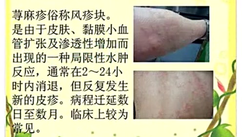 荨麻疹的治疗方法 注意事项要牢记