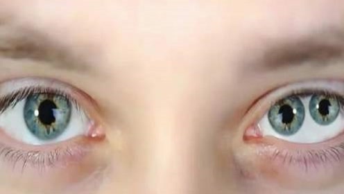 拥有"双瞳孔"的人,他们看到的世界,和普通人有什么不一样?