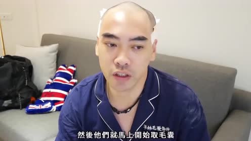 90后大叔花3个小时植发6000根,就为告别m型秃头和地中海
