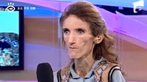 世界上最瘦的女人 曾经的大美女瘦成"干尸"