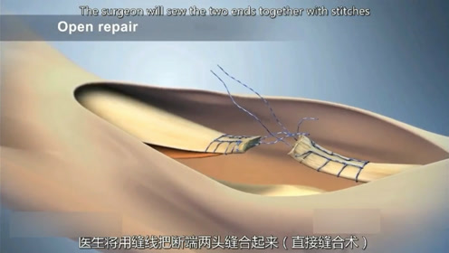 3d演示跟腱断裂修复手术,手术医生必然是好好裁缝!