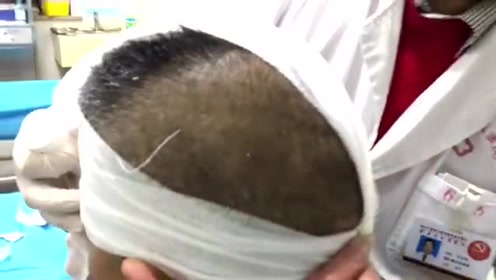 头部和额部二处伤口的绷带加压包扎